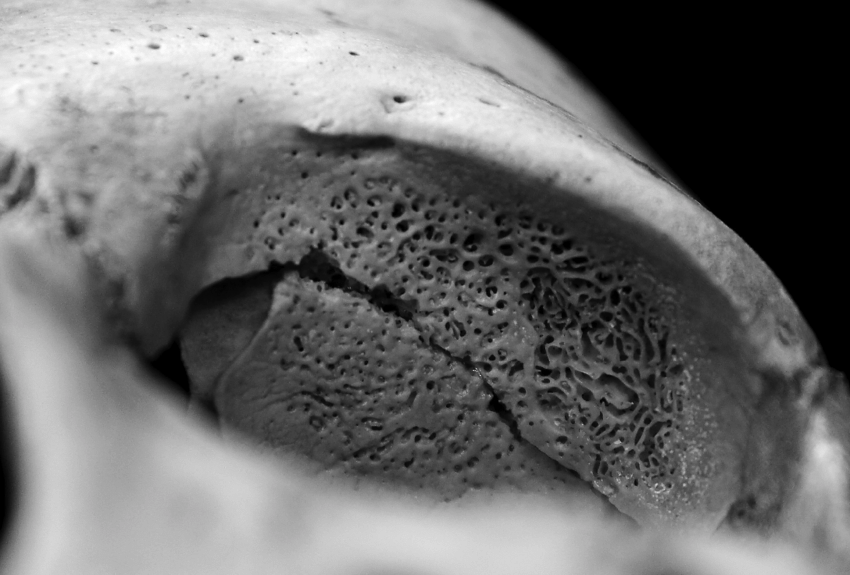image of anemia in top of eye socket.