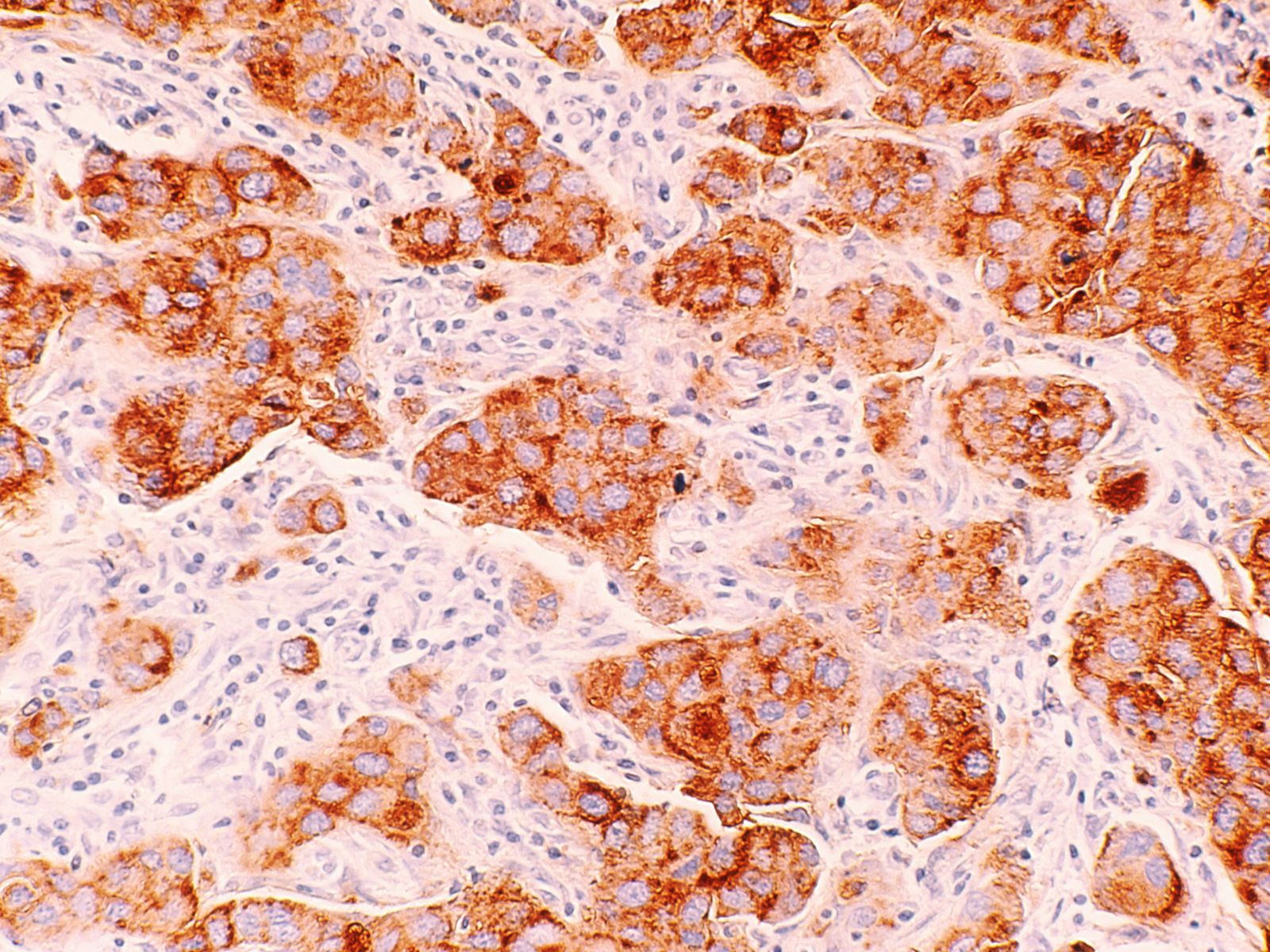 Type 2 Diabetes Blood Factors Drive Breast Cancer ...